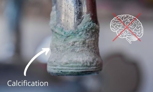 Pineal Calcification