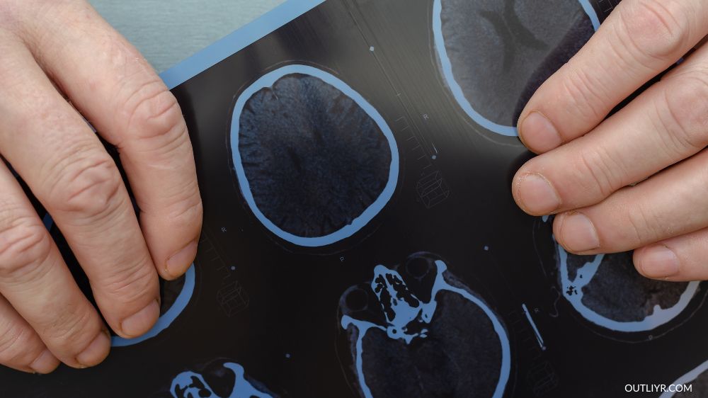 Concussion Treatment Brainscan